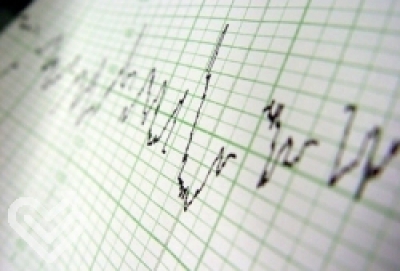 Long QT syndrome (LQTS)