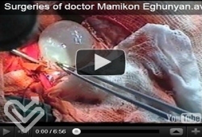 Surgeries of doctor Mamikon Eghunyan